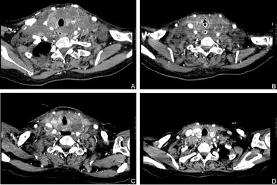 Case report: Visibly curative effect of dabrafenib and trametinib on advanced thyroid carcinoma in 2 patients